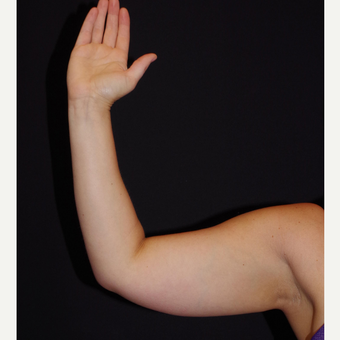 25-34 year old woman treated with Smart Lipo before 2998834