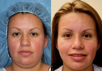 Rhinoplasty, neck liposuction, chin augmentation before 252416