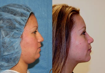 Rhinoplasty, neck liposuction, chin augmentation after 252416