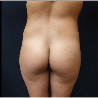 25-34 year old woman treated with 548cc Round Silicone Butt Implants for her Butt Augmentation before 3033281