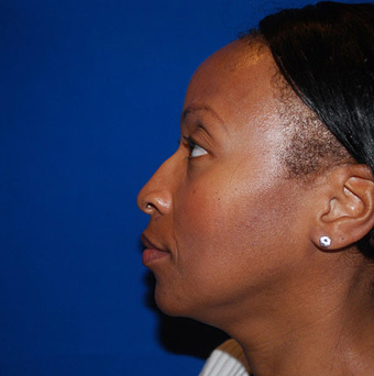 Chin Augmentation before 944863