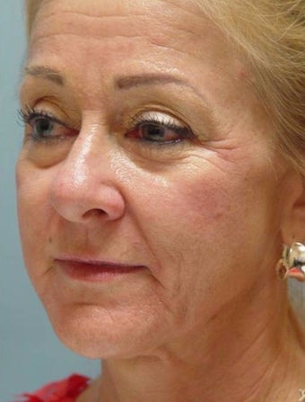55-64 year old woman treated with Bellafill before 1868534