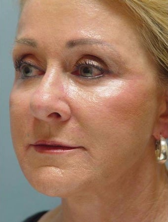 55-64 year old woman treated with Bellafill after 1868534