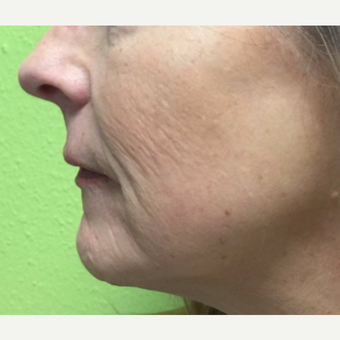 45-54 year old woman treated with Infini RF before 3816766