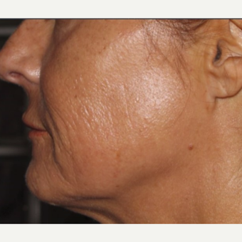 45-54 year old woman treated with Infini RF after 3816766