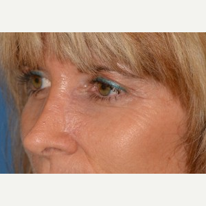 35-44 year old woman treated with Mohs Surgery after 3389216