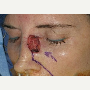 35-44 year old woman treated with Mohs Surgery before 3389216