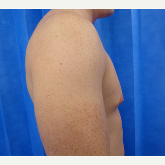 18-24 year old man treated with Male Breast Reduction before 3428615