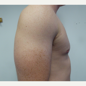 18-24 year old man treated with Male Breast Reduction after 3428615