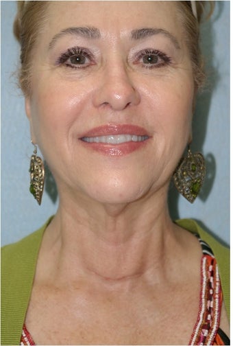 InMode Fractora to the Face and Neck after 1394349