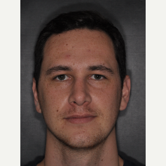 18-24 year old man treated with Nose Surgery 6 weeks post-op after 3499658