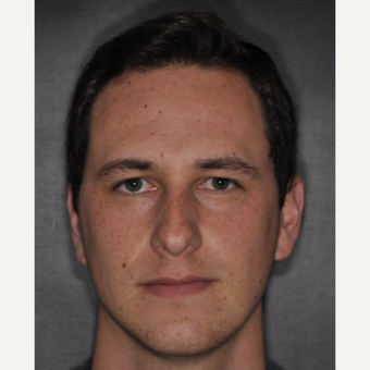 18-24 year old man treated with Nose Surgery 6 weeks post-op before 3499658