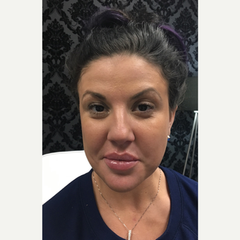 35-44 year old woman treated with Juvederm after 3804026