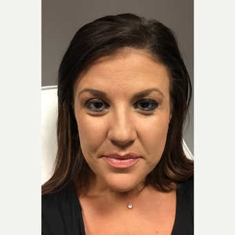 35-44 year old woman treated with Juvederm before 3804026