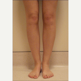 25-34 year old woman treated with Calf Implant after 3782020