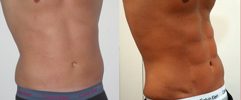 25-34 year old woman treated with Vaser Liposuction before 4599307