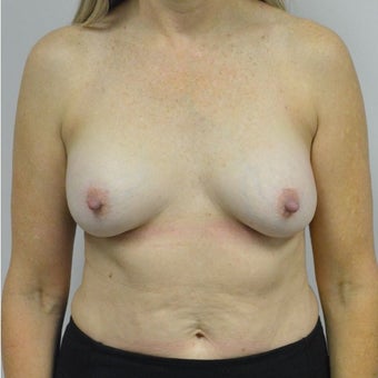 45-54 year old woman treated with Nipple reduction Surgery before 2507740