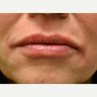 Lip Augmentation Using 1 syringe of Belotero after 2881956