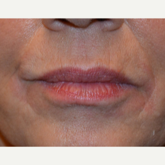 Lip Augmentation Using 1 syringe of Belotero before 2881956