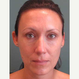 35-44 year old woman treated with Restylane to the lower eyes after 3713684