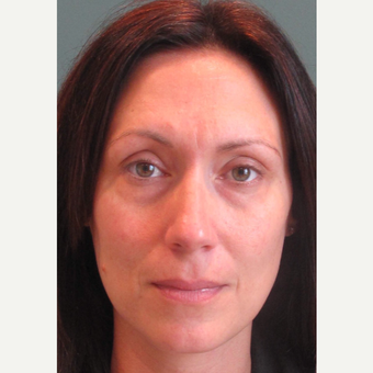 35-44 year old woman treated with Restylane to the lower eyes before 3713684