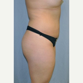 Brazilian Butt Lift before 2339713
