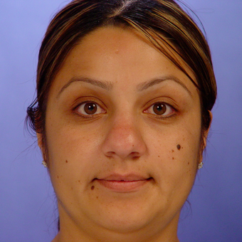 25-34 year old woman treated with Rhinoplasty before 3570272