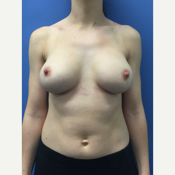 25-34 year old woman treated with Breast Augmentation after 3415710