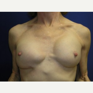 Breast Implant Revision before 3164453