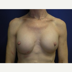 Breast Implant Revision after 3164453