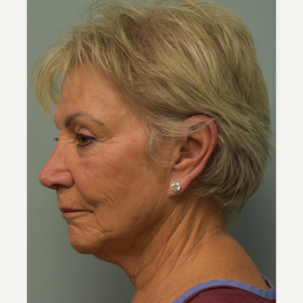 65-74 year old woman treated with Mini Lift before 2667040