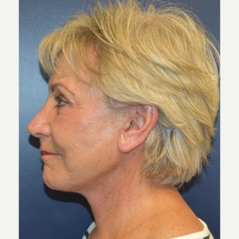 65-74 year old woman treated with Mini Lift after 2667040
