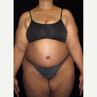45 year old woman treated with Tummy Tuck after 2476981