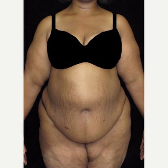 45 year old woman treated with Tummy Tuck before 2476981