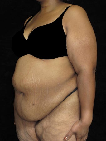 45 year old woman treated with Tummy Tuck 2476981