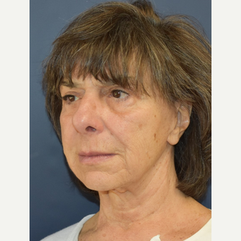 65-74 year old woman treated with Neck Lift before 3214028