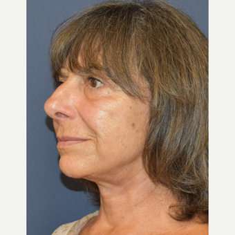 65-74 year old woman treated with Neck Lift after 3214028