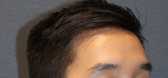 28 year old male - Forehead Reduction after 2724608