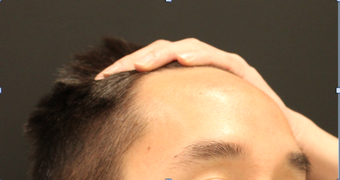 28 year old male - Forehead Reduction before 2724608