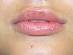 25-34 year old woman treated with Lip Augmentation after 2986765