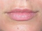 25-34 year old woman treated with Lip Augmentation before 2986765