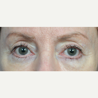 65-74 year old woman treated with Eyelid Surgery after 3440673