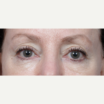 65-74 year old woman treated with Eyelid Surgery before 3440673