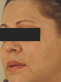 IPL Photofacial with Q-switched lasers. after 151332