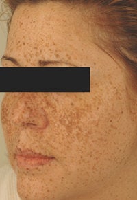 IPL Photofacial with Q-switched lasers. before 151332