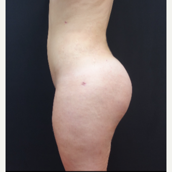18-24 year old woman treated with Fat Transfer after 3315547