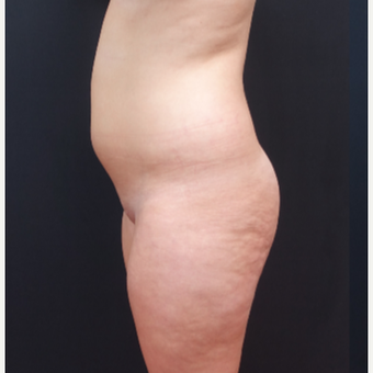 18-24 year old woman treated with Fat Transfer before 3315547