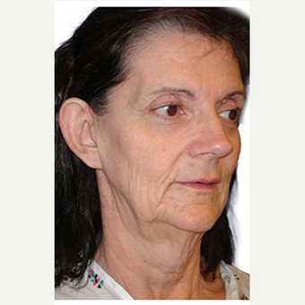 52 year old woman treated with Fat Transfer before 3548850