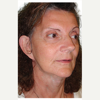 52 year old woman treated with Fat Transfer after 3548850