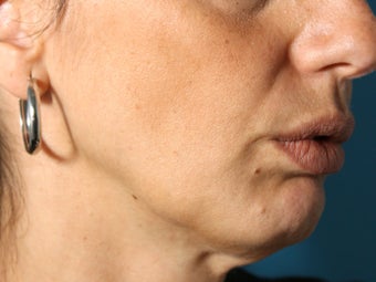 Radiesse filler for jowls and nasolabial folds (liquid facelift) before 936993